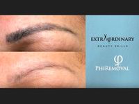 PhiRemoval permanent makeup Tattoo microblading Entfernung nrw Dortmund - Mitte Vorschau