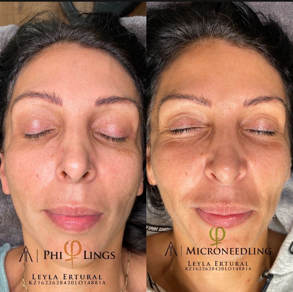 Microneedling Philings AntiAging PlasmaPen Akne  Kosmetik in Köln