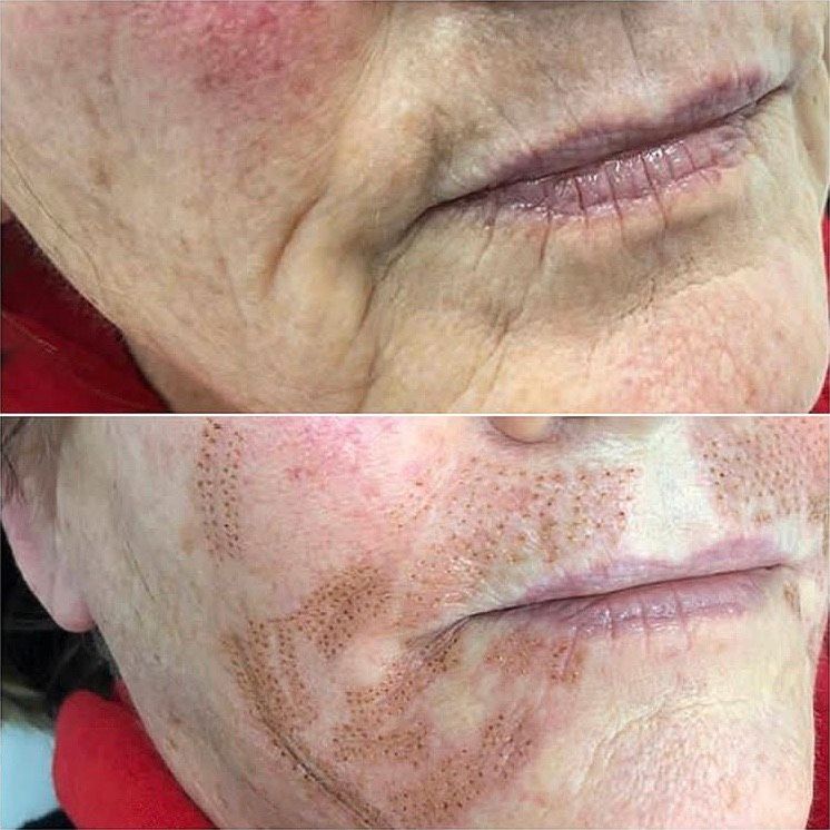 Plasma Pen Microneedling Kombi Schulung mobil in Paderborn