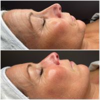 Microneedling bei Narben, Pigmentflecken und Falten! München - Pasing-Obermenzing Vorschau