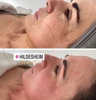 Microdermabrasion, Diamant-Microdermabrasion Niedersachsen - Hildesheim Vorschau