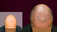 Krankheitsbedingter Haarausfall - Haarpigmentation - Alopezie Bayern - Landsberg (Lech) Vorschau