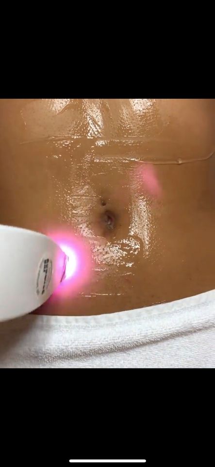 Diodenlaser dauerhafte Haarentfernung Laser Ganzkörper 150€ in Sachsenheim