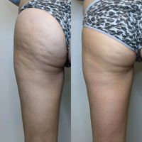 Angebot! Maderotherapie - Anti Cellulite/ Wassereinlagerungen Hannover - Linden-Limmer Vorschau