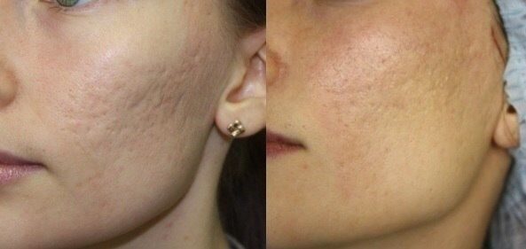 Microneedling Meso  mit Microdermabrasion und Heimpflege Produkte in Barsinghausen