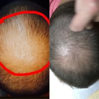 Haarwachstum-Micro-Needling Behandlung Hessen - Bad Vilbel Vorschau