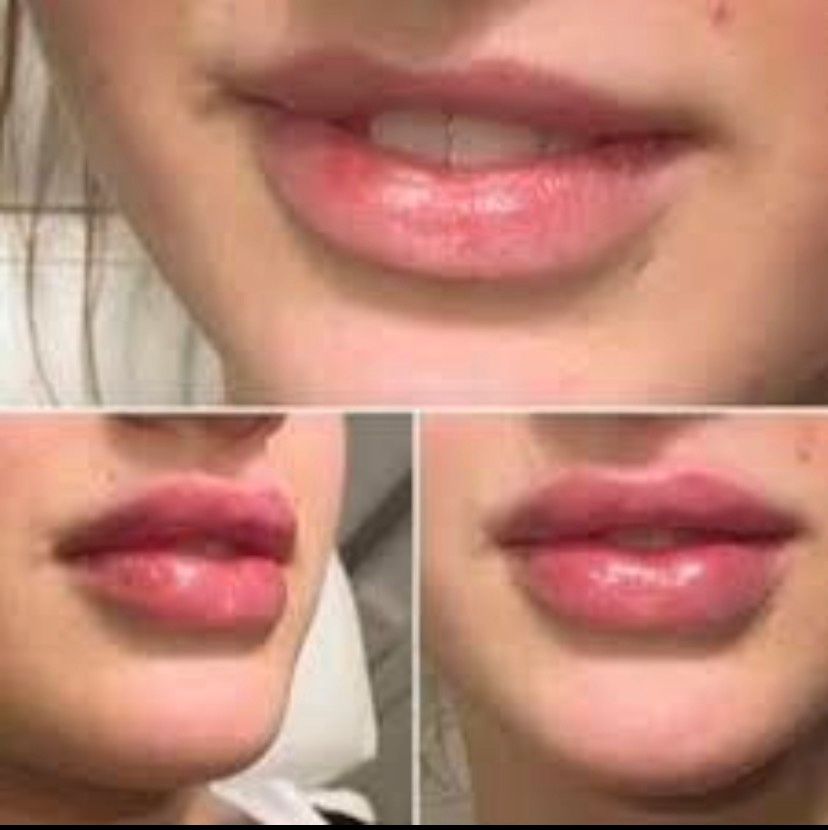 99 € Aktion Hyaluron Filler Lippen Volumenaufbau Falten Russian in Duisburg