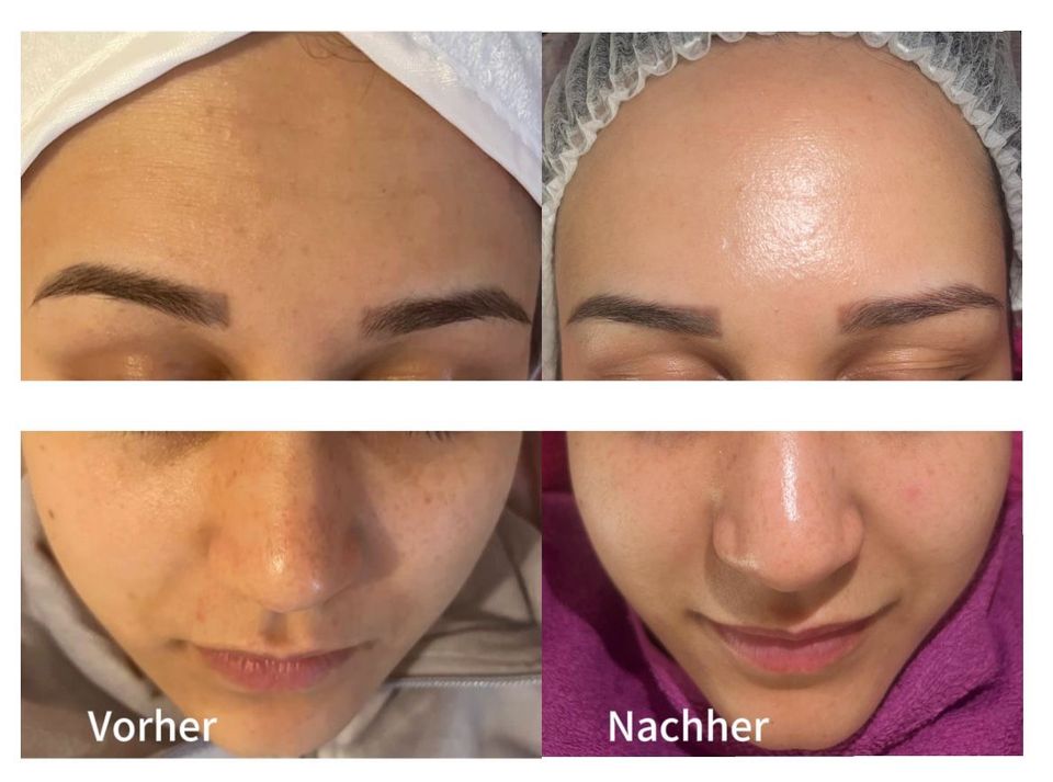 Aquafacial Aquapeeling Gesichtsbehandlung Kosmetikbehandlung in Schwarzenbek