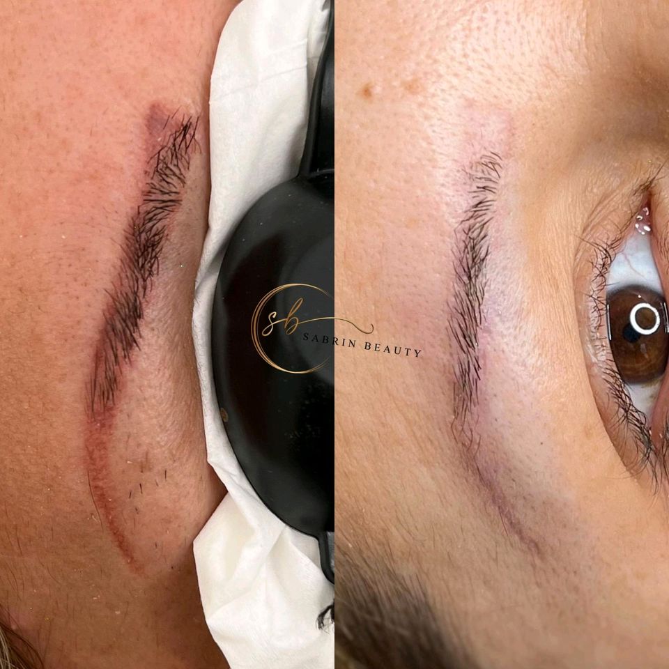Entfernung microblading permanent Make-up Tattoos Remover in Bottrop