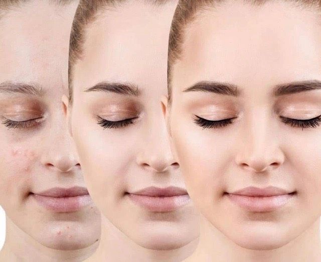 Microneedling + BB Glow Gesichtsbehandlung in München