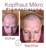 Haar Tricho Micropigmentierung Kopf Haarausfall Haar Tattoo Kiel - Kiel - Vorstadt Vorschau