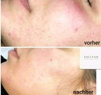 Microneedling Duisburg - Meiderich/Beeck Vorschau