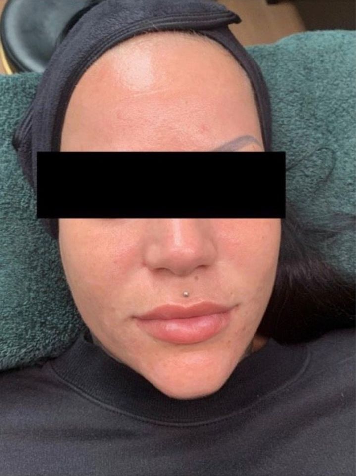 Microneedling Gesichtsbehandlung Hautbehandlung Kosmetik in Seevetal