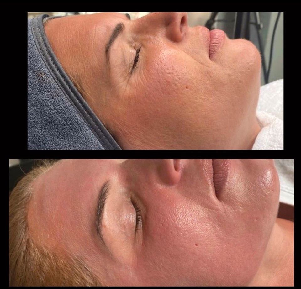 Microneedling , BB-Glow, Gesichtsbehandlung, Beauty in Melbeck in Lüneburg