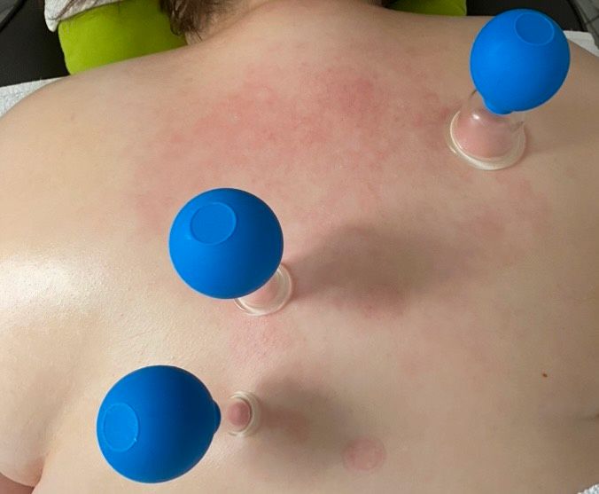 Weiterbildung Schulung trockene Schröpfmassage & Gua Sha Wellness in Kreuztal