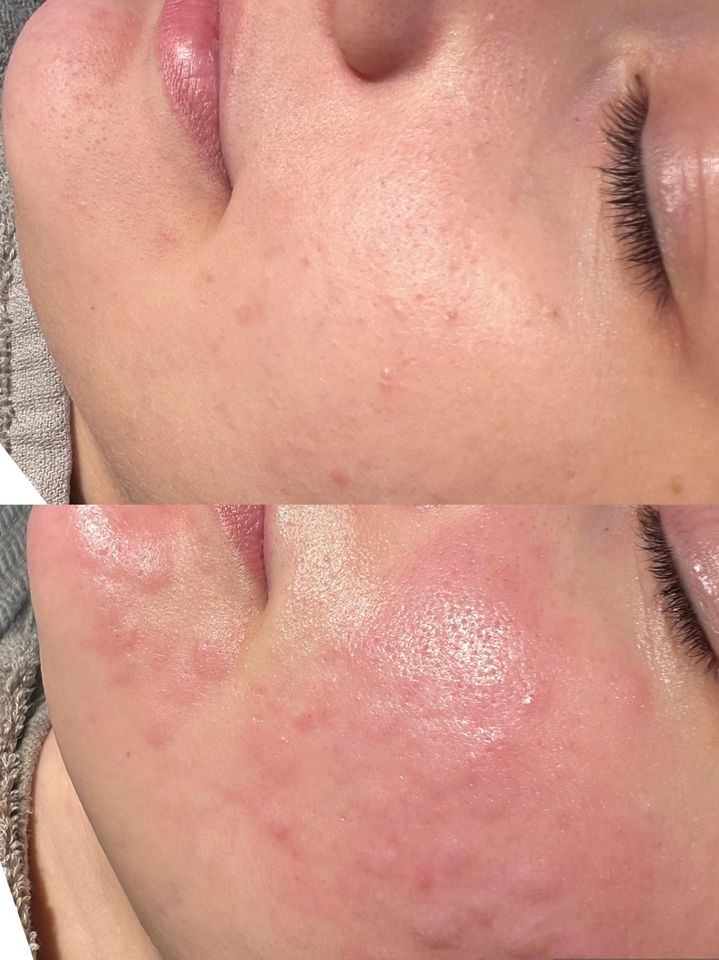 Diamant Microdermabrasion für nur 79€ in Duisburg