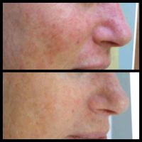 Rosacea/ Couperose Anti Redness Behandlung Nordrhein-Westfalen - Detmold Vorschau