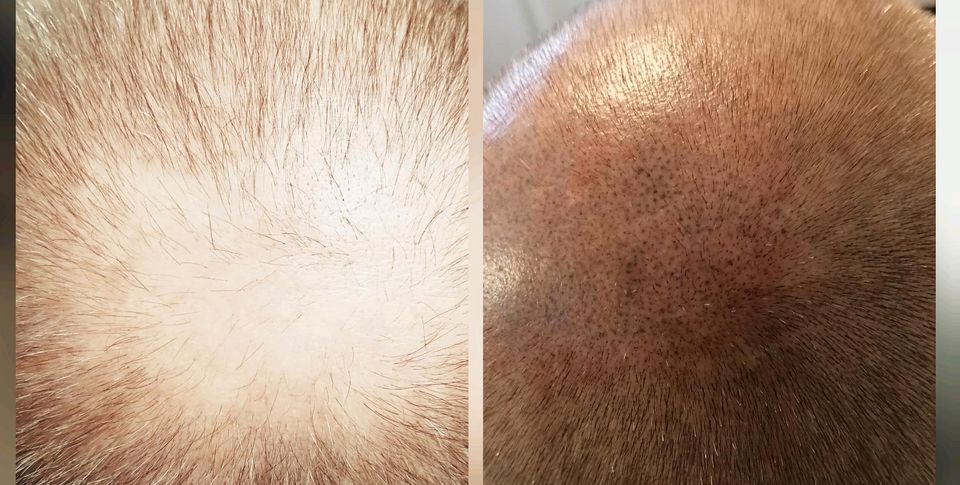 Needling bei Haarausfall, Scalp Kopfhaut Behandlung medical Behan in Großrosseln