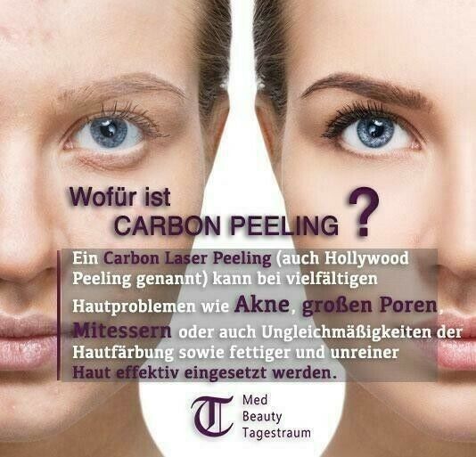 Laser-Peeling mit Carbon Peeling Hautverjüngerung Akne ANGEBOT Ha in Hamburg