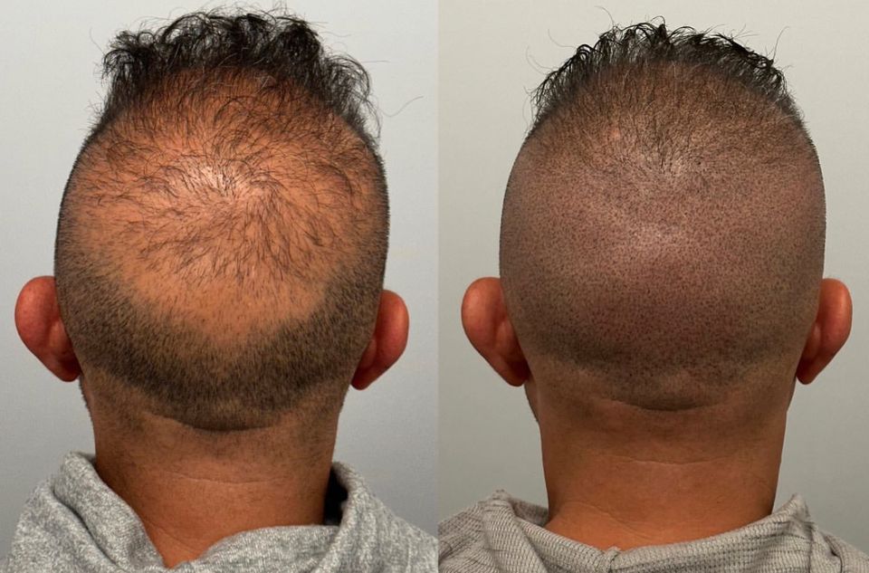 Haarpigmentierung Hair Tattoo in Rosenheim SMP Scalp Micro Pigmentation Haartätowierung Haar Pigmentierung Rosenheim in Rosenheim