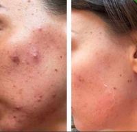 Carbon laser Peeling Hollywood peeling Nordrhein-Westfalen - Langenfeld Vorschau