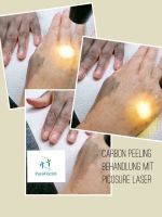 Carbon Laser Peeling Behandlung mit PicoSure Laser Saarland - Nonnweiler Vorschau