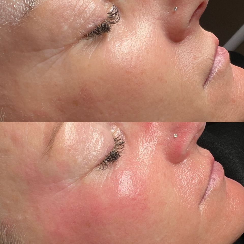 BB Glow / Microneedling in Hannover