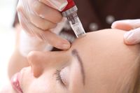 Microneedling, Gesichtsbehandlung Bayern - Teublitz Vorschau