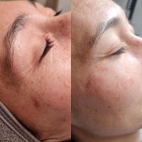 Aquafacial/Microneedling Schulung Niedersachsen - Duingen Vorschau