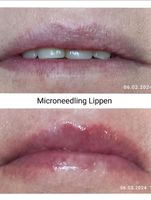 Meso Microneedling Lippen Häfen - Bremerhaven Vorschau