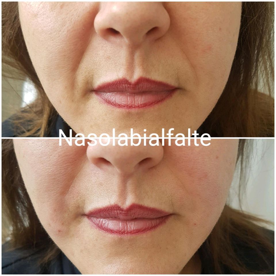 Russian Lips, Hyaluron, Filler, Lippenunterspritzung, Falten in Duisburg