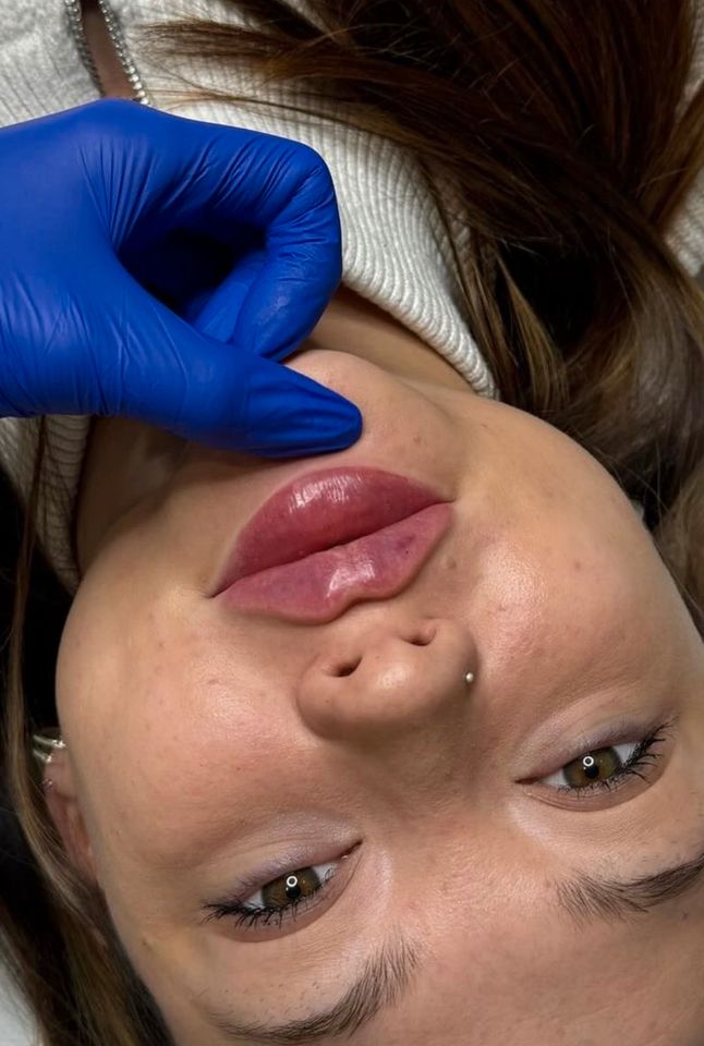 Russianlips Lippen Hyaluron Botox in Hamburg