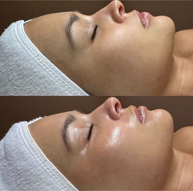 Microneedling in Gelsenkirchen