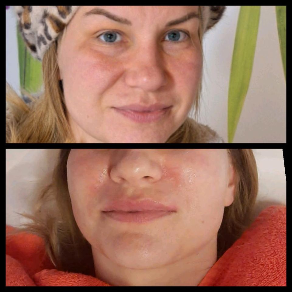 Plasma Pen MicroNeedling Microdermabrasion Hyaluron Anwendung in Seligenstadt