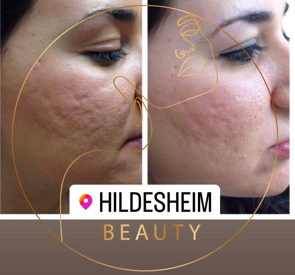 Microneedling ein eben Neues Hautbild Gesichts Reinigung. in Hildesheim