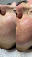 Microneedling Gesichtsbehandlung Nordrhein-Westfalen - Porta Westfalica Vorschau