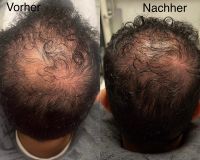 Microneedling gegen Haarausfall Berlin - Spandau Vorschau