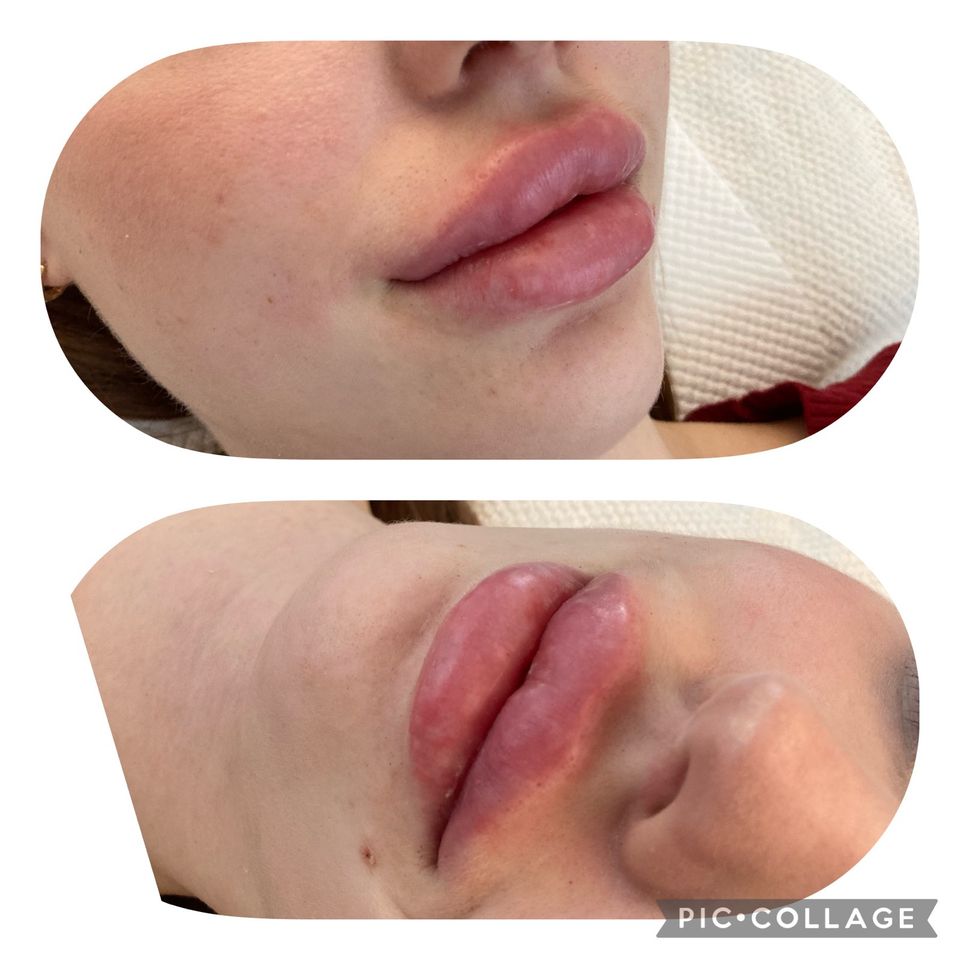 Lippen- & Faltenunterspritzung * Contouring in Hamburg