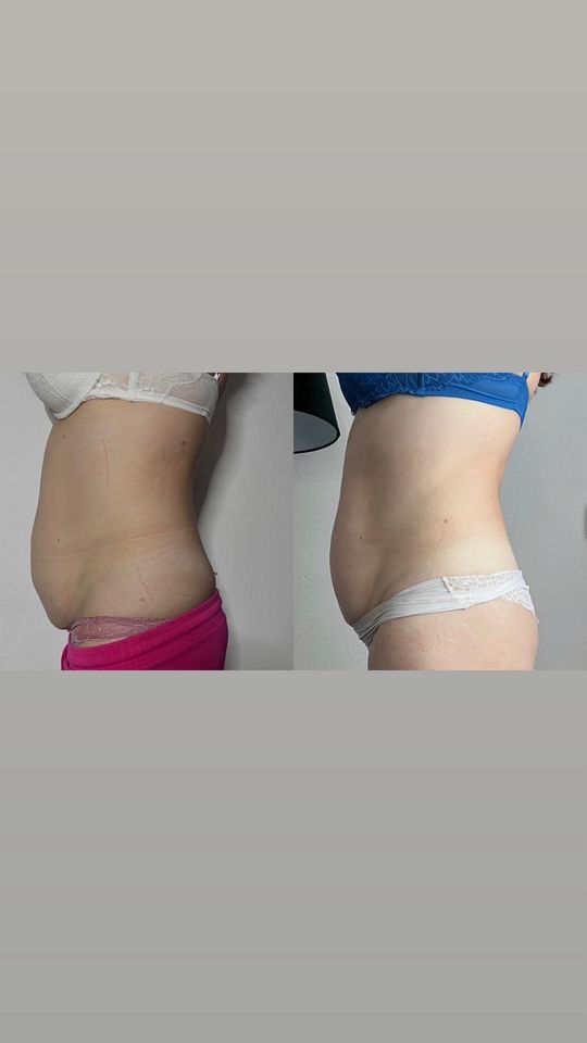 Körperformung, cellulite in Saarbrücken