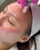 Mikrodermabrasion + Microneedling Hannover - Mitte Vorschau