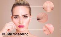 Microneedling RF ( mit Radiofrequenz ) Gesicht Behandlung Nordrhein-Westfalen - Ibbenbüren Vorschau