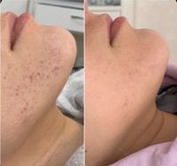 Microneedling / BB GLOW Münster (Westfalen) - Centrum Vorschau