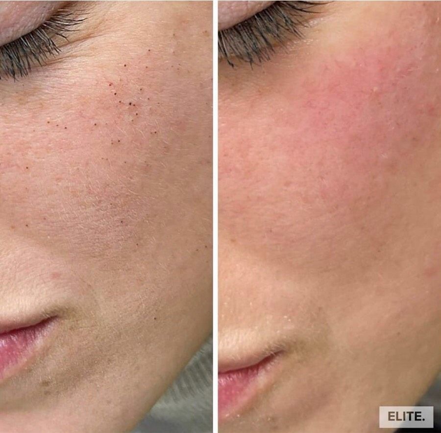 Diamant microdermabrasion gesichtsbehandlung in Düsseldorf