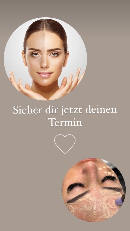 BB Glow - Microneedling Bitte bei WhatsApp schreiben ! in Barsinghausen