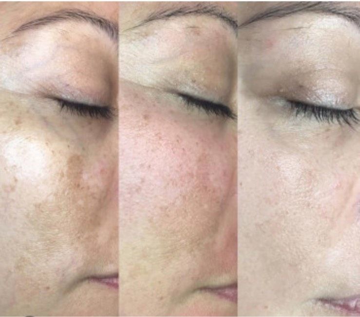 Bb glow Microneedling in Bottrop