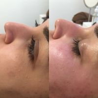 Microneedling für nur 99€! Duisburg Duisburg - Duisburg-Mitte Vorschau