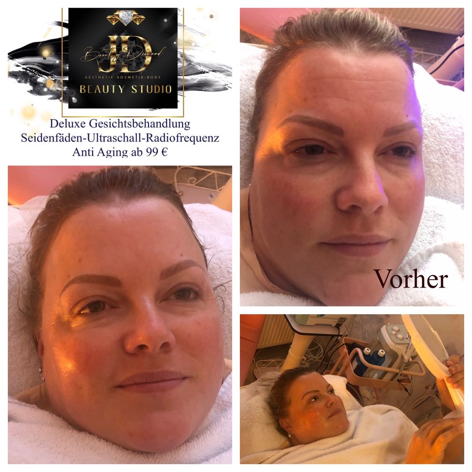 Fadenlifting ohne Nadel ⭐️Anti Aging Behandlung Vampirpeeling in Dortmund