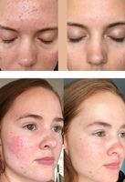 Microneedling ( spezifisch für Akne - massive Pickel ) Saarland - Dillingen (Saar) Vorschau