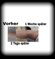 Tattoo und Pigmentfleckenentfernung Nordrhein-Westfalen - Gelsenkirchen Vorschau
