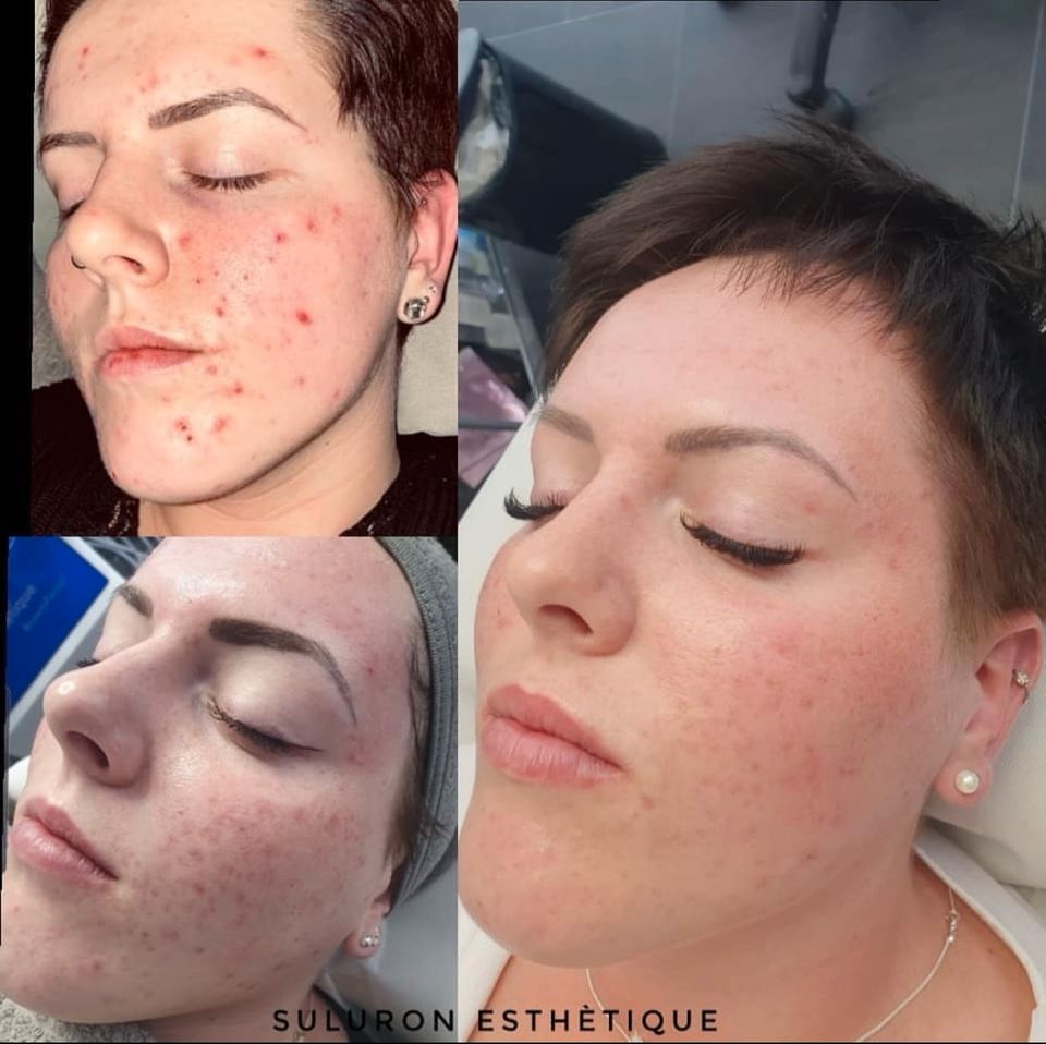 Professionelle Microneedling / BB-Glow Kombi Schulung in Flörsheim am Main